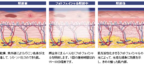 フォトフェイシャルの光はターゲットのみに反応するため、素肌を傷つけることなく、トラブル部分のみにダメージを与えることができます。